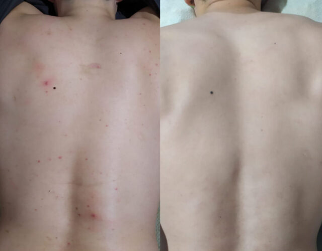 jabon-artesano-de-carbon-activo-para-eliminar-el-acne Jabón artesano de carbón activo
